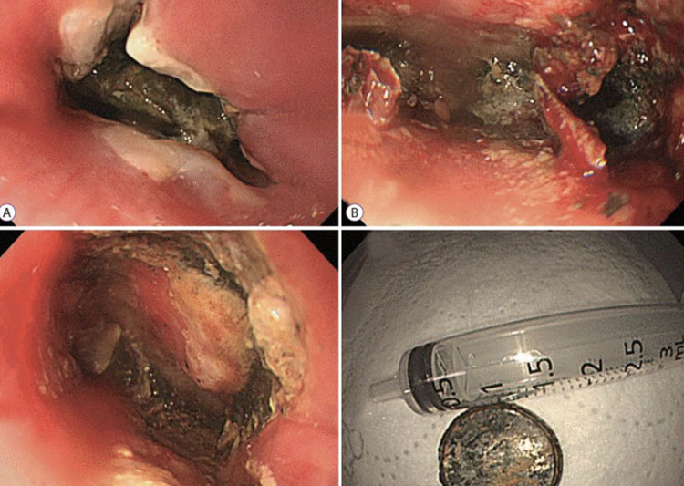 ابتلاع بطارية ليثيوم